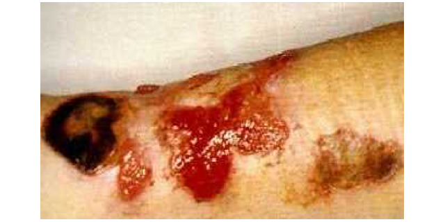 photo of lesions of necrotising arachnidism on patients arm 