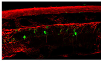 Glial change in neurodegenerative disease of the retina