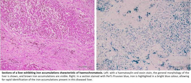 Left image: a microscopic section of a sample of liver from an individual with haemochromatosis; the section is stained with haematoxylin and eosin. Right: a microscopic section of a sample of liver from an individual with haemochromatosis; the section is stained with Perl's Prussian blue, causing iron accumulations in the tissue to appear bright blue. 