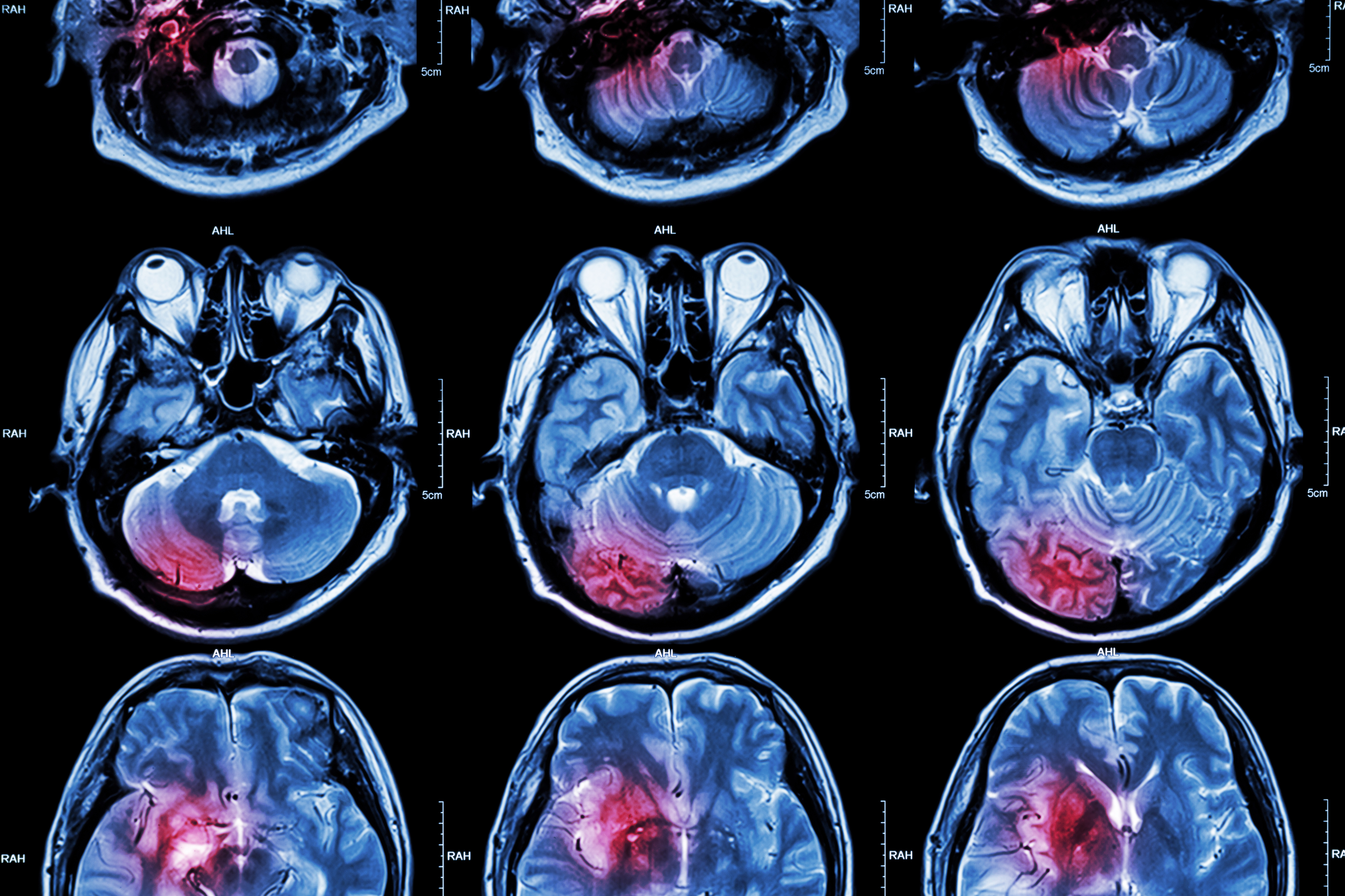 Brain scans with red areas suggesting injury